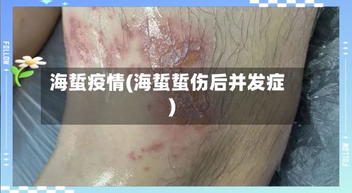 海蜇疫情(海蜇蜇伤后并发症)-第2张图片