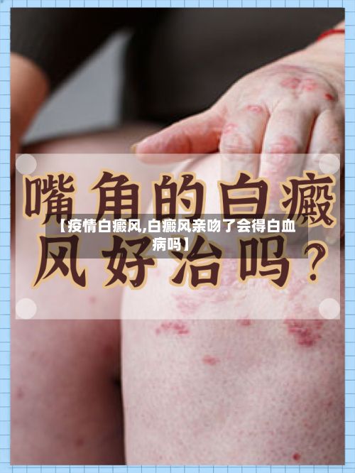 【疫情白癜风,白癜风亲吻了会得白血病吗】