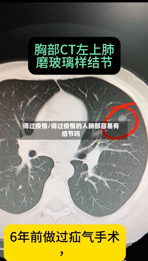 得过疫情/得过疫情的人肺部容易有结节吗-第2张图片
